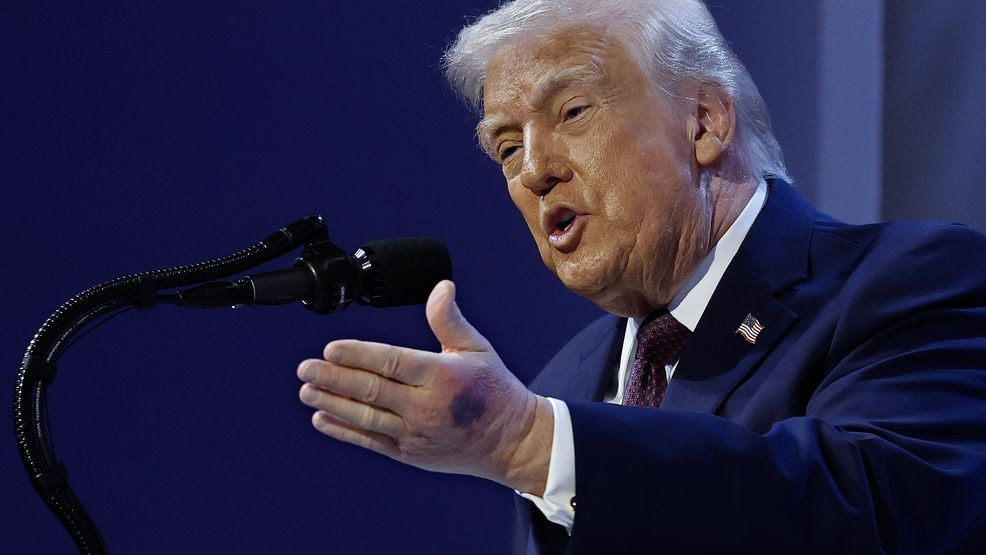 Image for story: Big bruise spotted on Trump's hand during World Economic Forum
