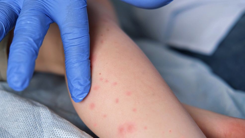 Image for story: Health officials sound alarm as South Carolina measles cases top 500
